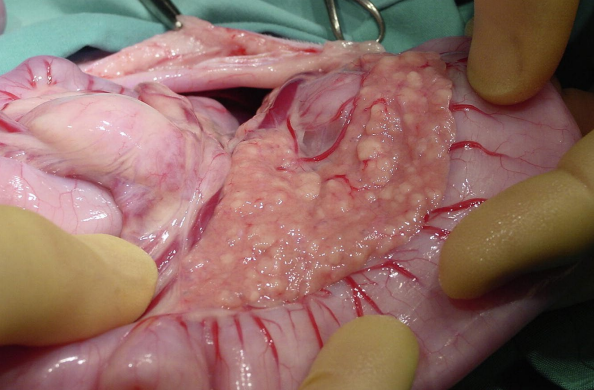 <p>Pancreas from an 8-year-old, spayed female, mixed breed cat. The cat has diabetes mellitus which you have been managing well for the past year. She presented with a history of hyporexia progressing to anorexia, lethargy, vomiting, and diarrhea. Morphological diagnosis?</p>