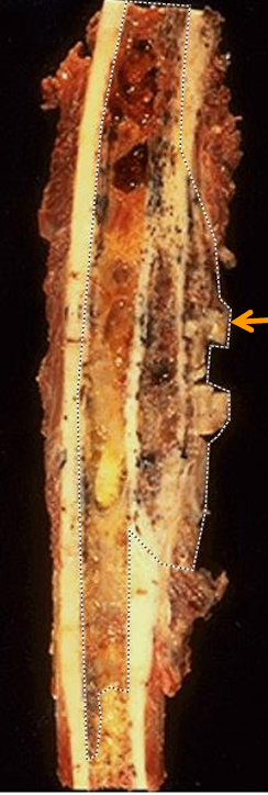 <p>Irregular tumor mass breaking through the bone cortex</p>