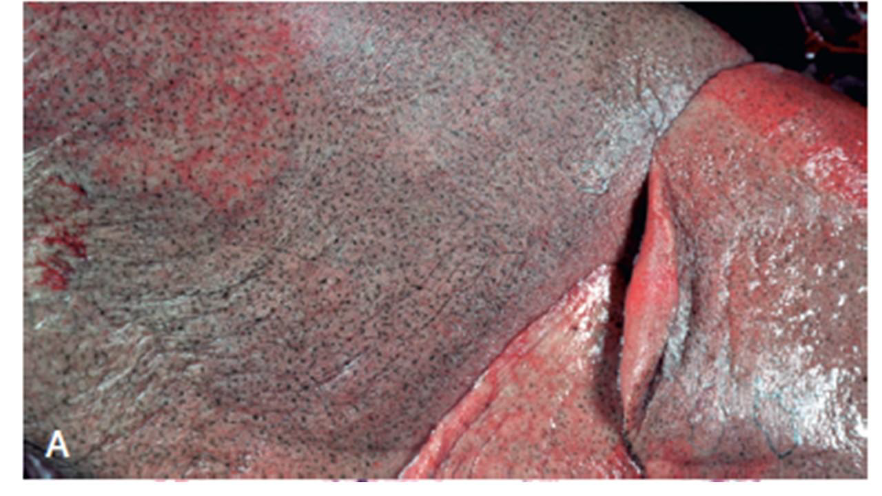 <p>anthracosis</p>