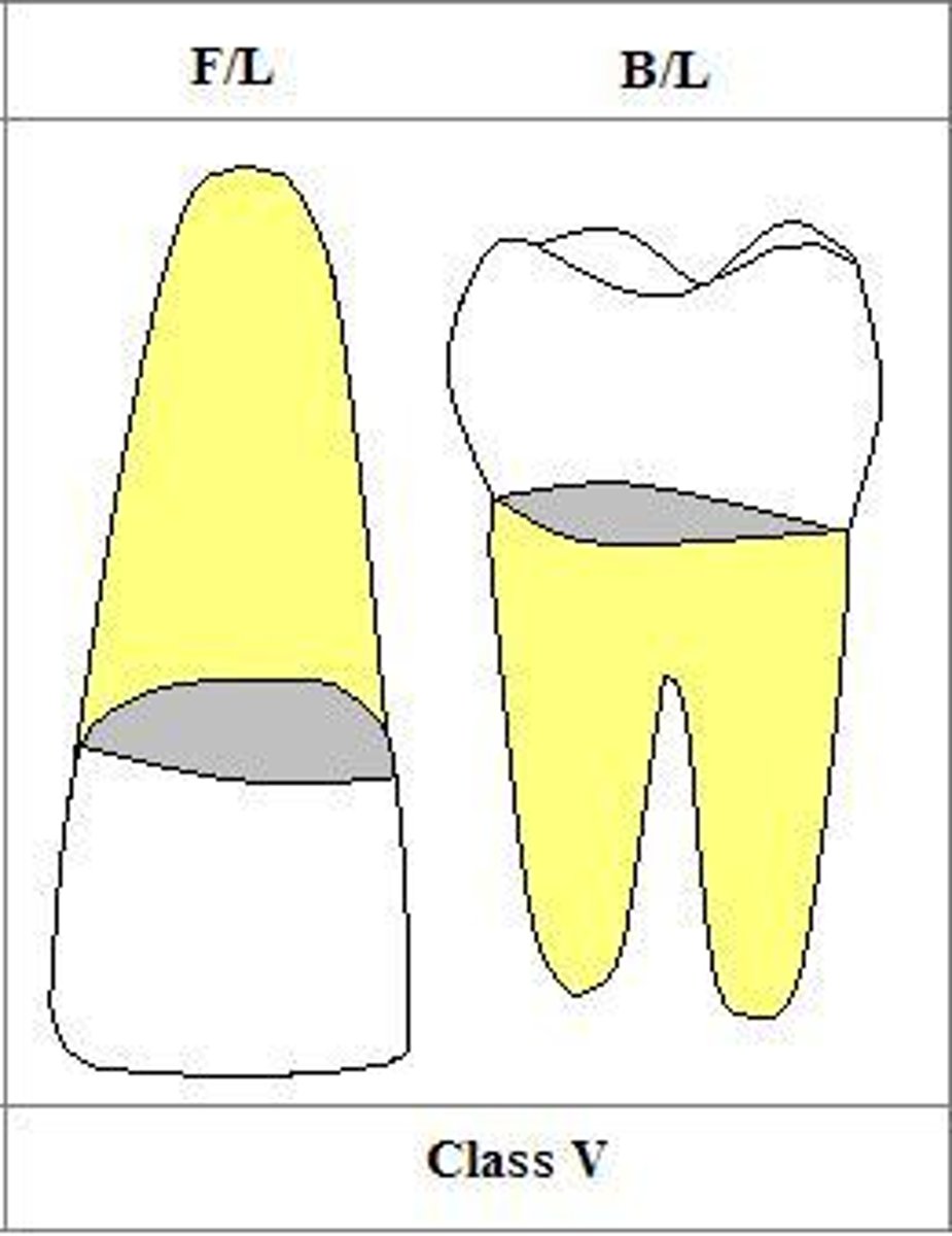 <p>1. beveled</p><p>2. 0.5 mm deep</p><p>3. at 45 degrees</p><p>4. Only that portion of the enamel receives a bevel</p><p>5. "butt joints all around"</p><p>6. no bevels</p>