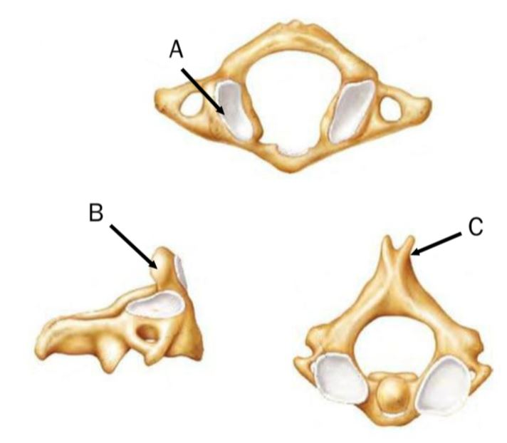 <p>which is the dens or odontoid process</p>