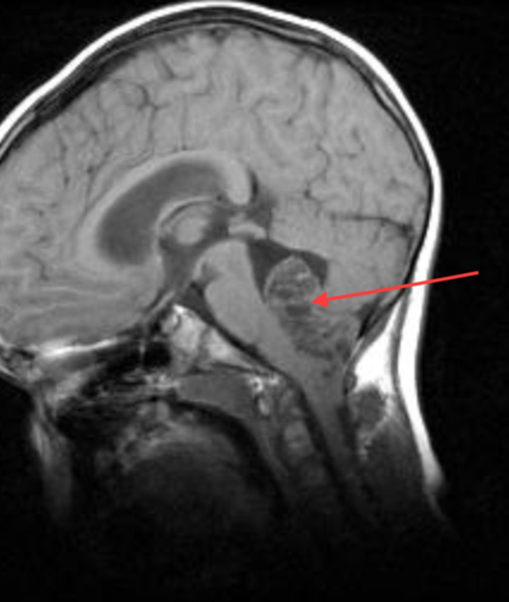 <p>Tumor arising from the wall of the fourth ventricle, especially in children, and the lateral ventricles in adults</p><p>- non capsulated makes surgery hard</p>