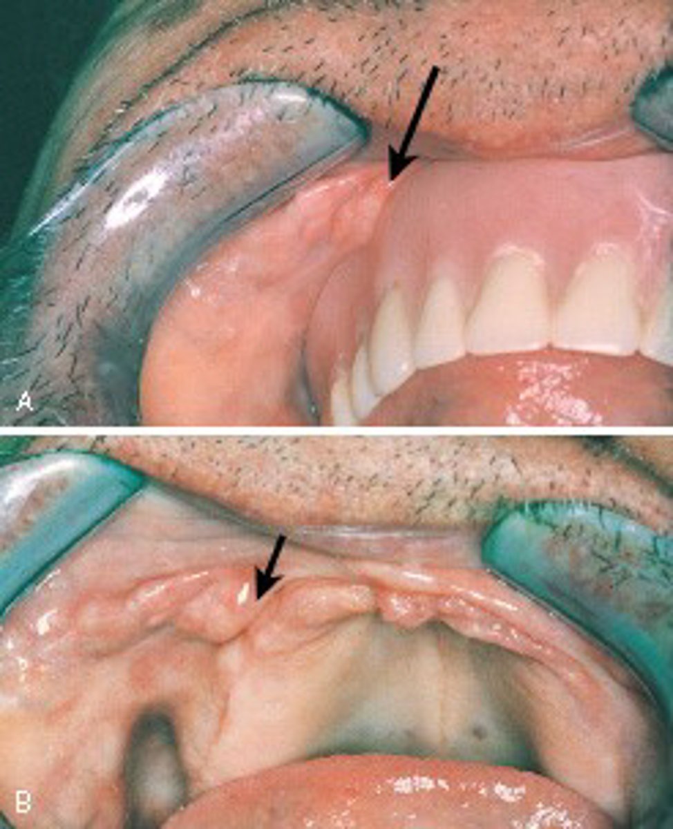 <p>epulis fissuratum.</p><p>Epulis fissuratum (denture-induced fibrous hyperplasia) consists of elongated folds of tissue as a result of irritation from an ill-fitting denture. Palatal papillomatosis is seen on the palate. Gingival hyperplasia is an enlargement of the gingiva. Chronic hyperplastic pulpitis is an excessive proliferation of chronically inflamed dental pulp tissue.</p>