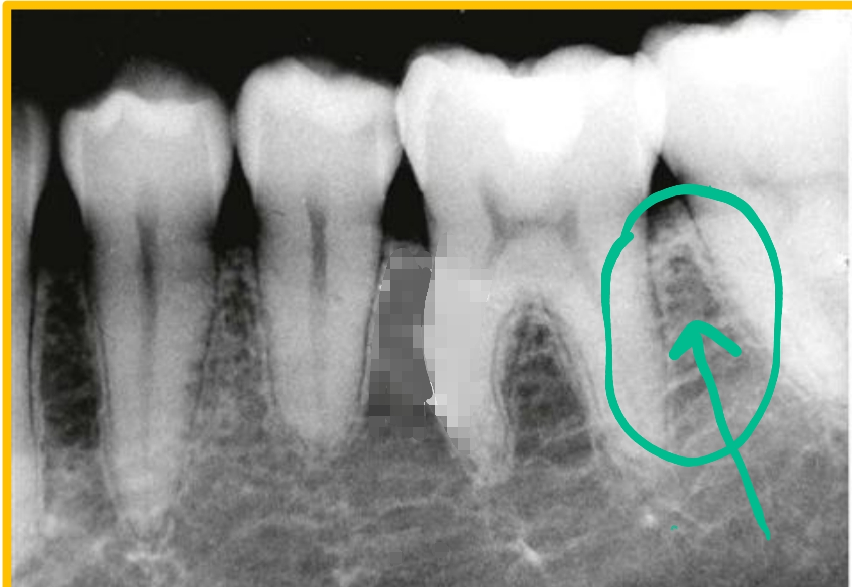 <p>located between teeth</p>