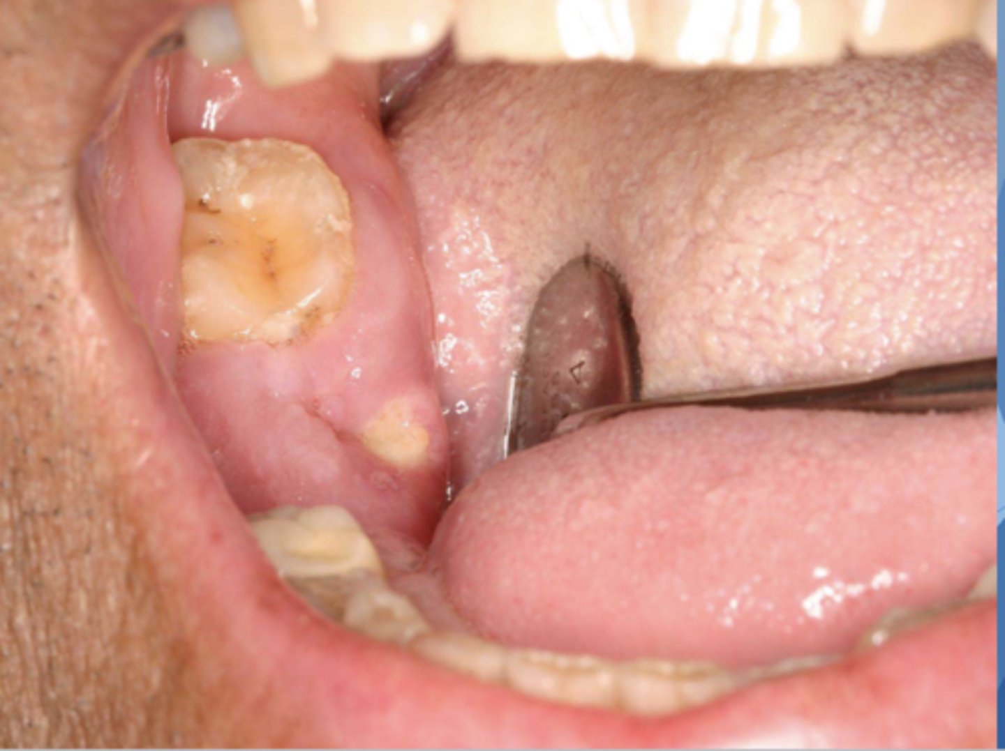 <p>Patient has multiple myeloma and is currently on chemotherapy and taking Flosamax (Alendronate). What do you suspect?</p>