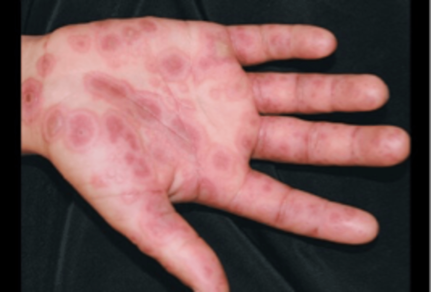 <p>name the skin pathology</p>