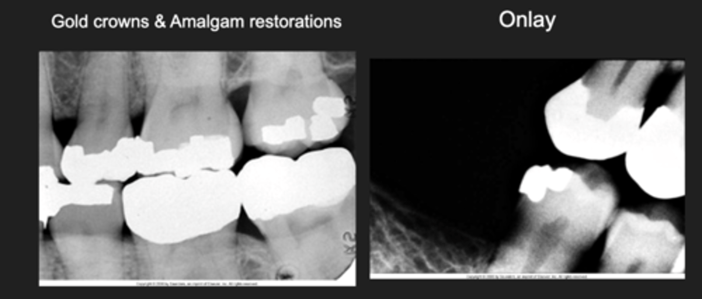 <p>- Gold crowns and amalgam restorations and onlay</p>