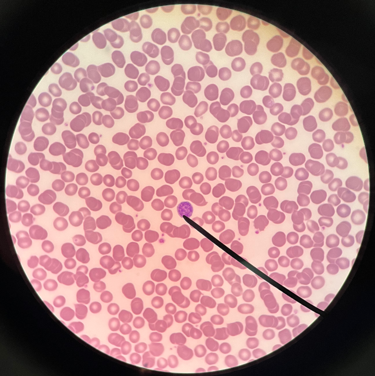 • Leukocyte and agranulocyte.

• Appears with a nucleus filling most of the cell and a small rim of cytoplasm.

• Second-most abundant leukocyte.

• Several types: B lymphocytes, plasma cells, cytotoxic T lymphocytes, and natural killer (NK) cells.

• Count increased by bacterial, viral, and fungal infections; or leukemia.

• Count decreased by immune diseases or anti-inflammatory treatments.