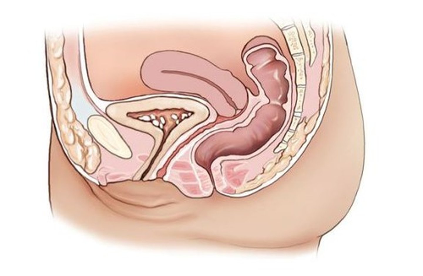 <p>stone in the bladder</p>
