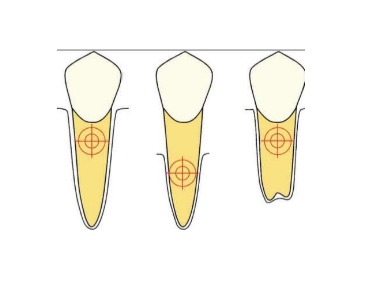 <p>Alveolar bone height and root length. Uses clinical root. Alveolar bone loss - shortened root.</p>