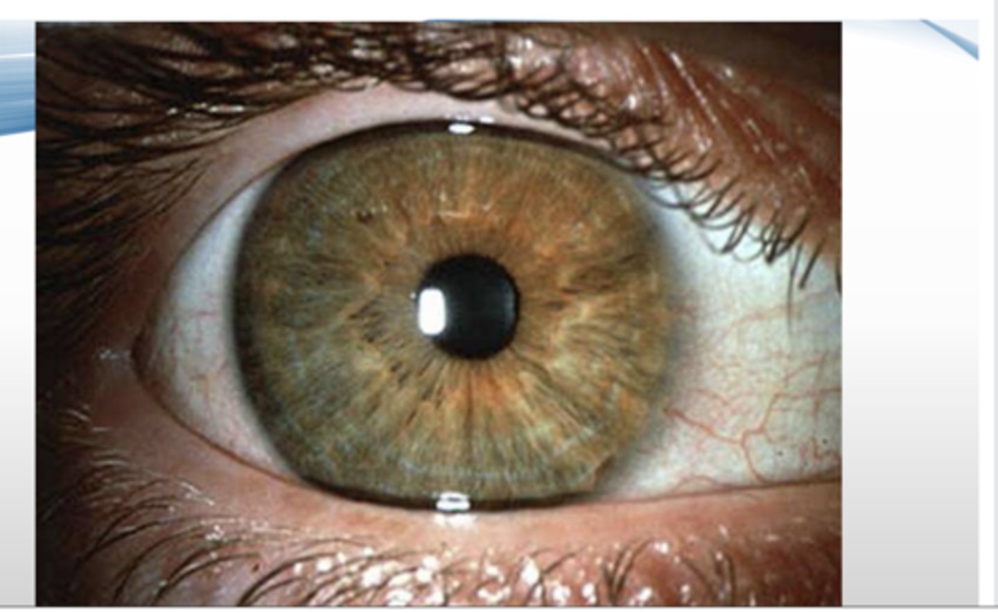<p>pathognomonic deposition of copper in cornea seen in wilson's disease</p>