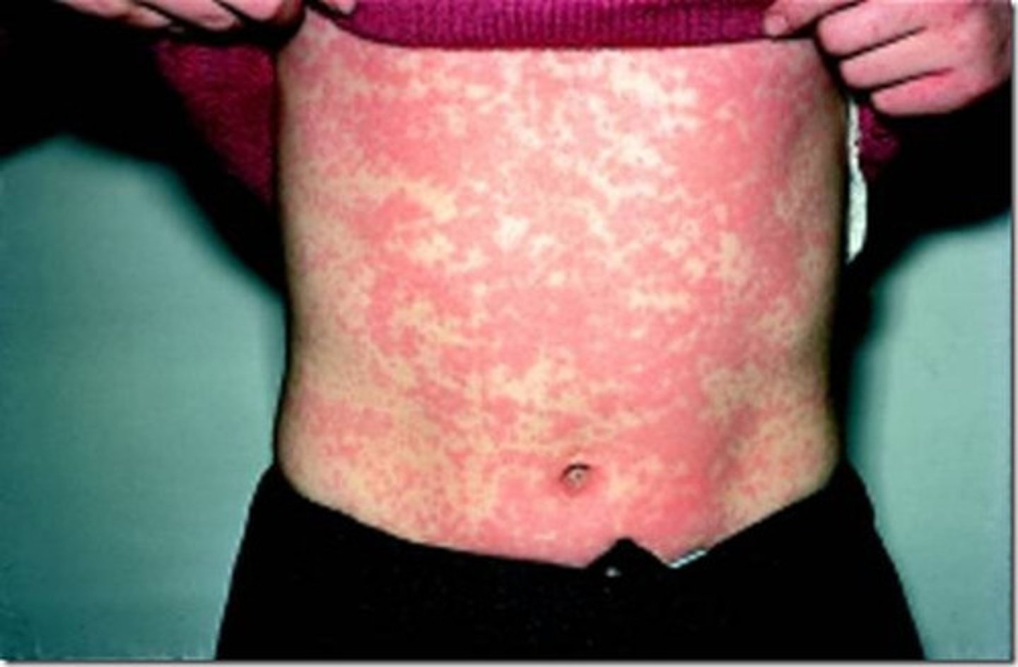 <p>Immunization produces Antigen-Antibody complexes that are stored in tissues and cause a harmful reaction to the body's tissues</p>