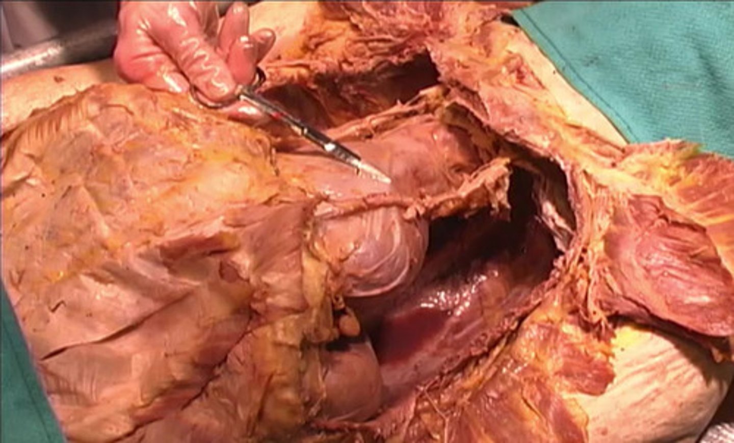 <p>What is the name of this structure with a thin membrane?</p><p>Thoracic Sac</p><p>Fibrous Sac</p><p>Pericardial Sac</p><p>Pectoralis Sac</p>