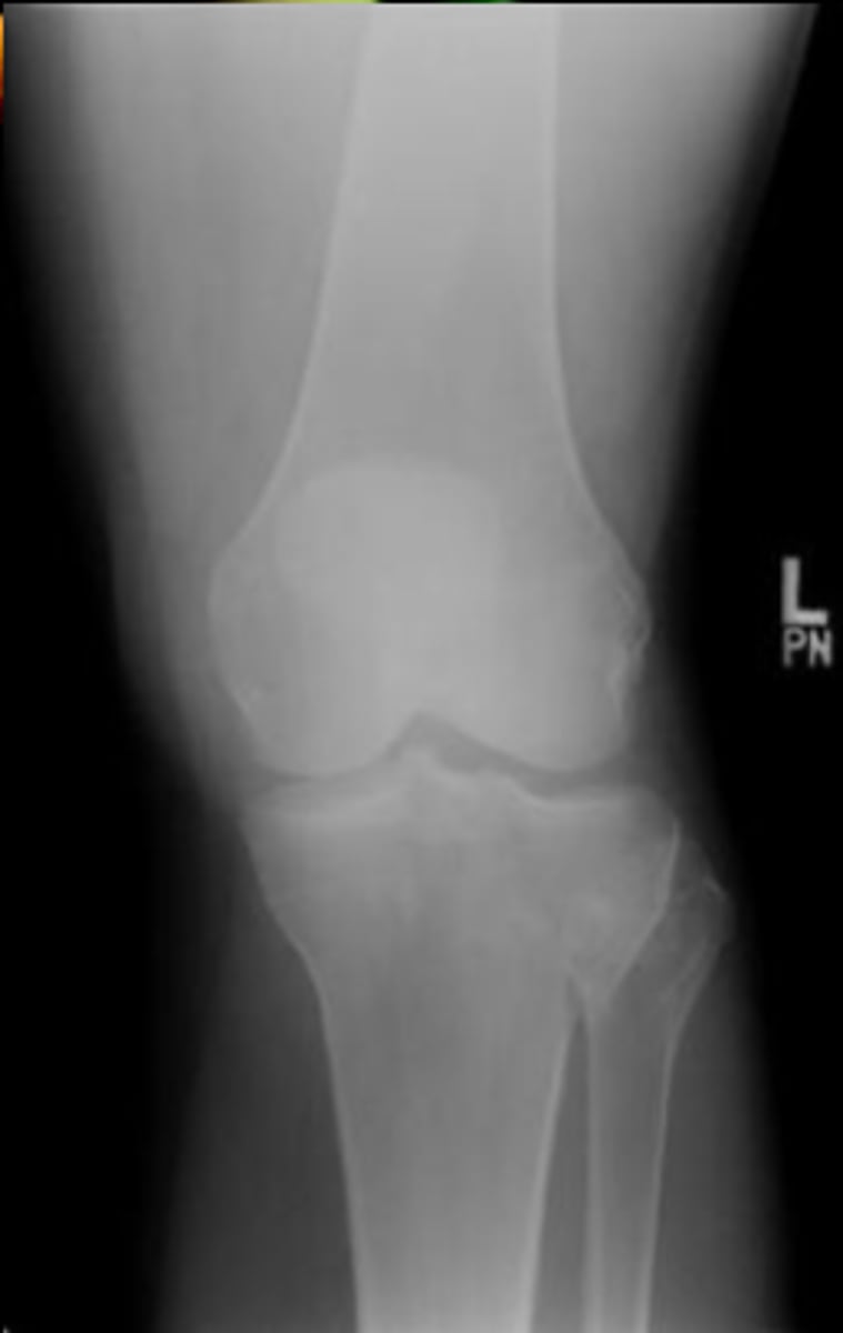<p>valgus and compressive forces to knee with knee in flexion. often in conjunction with MCL injury.</p>