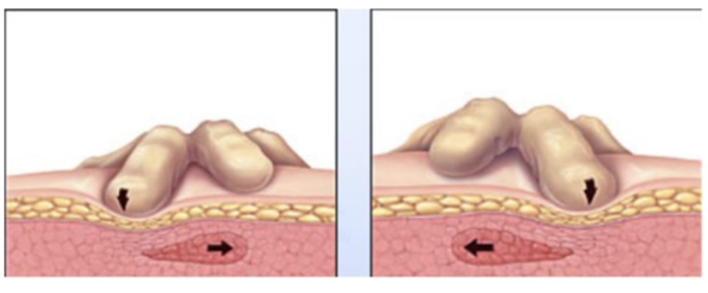 <p>Localized, painful, or sensitive areas in skeletal muscle</p><p>- Associated w/ palpable nodules</p><p>- In taut bands of muscle fibers</p>
