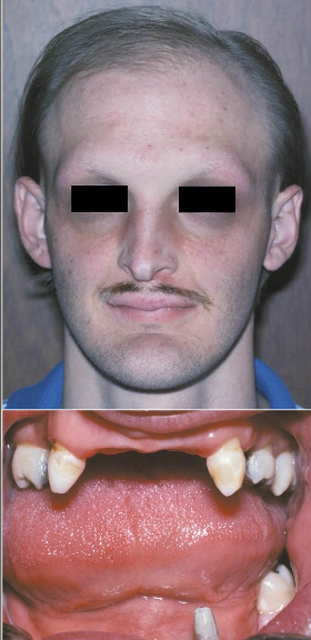 <p>An inherited condition where multiple ectodermally derived anatomic structures fail to develop.</p>