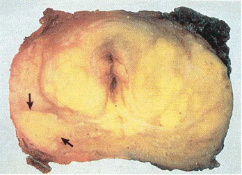 A routine physical examination of the 70-year-old African American man showed an indurated mass in the posterior lobe of the prostate gland on rectal examination, and laboratory screening showed an increased PSA was noted. Below is a photograph and photomicrograph of this patient's lesion, not the lesion indicated by the arrow.  