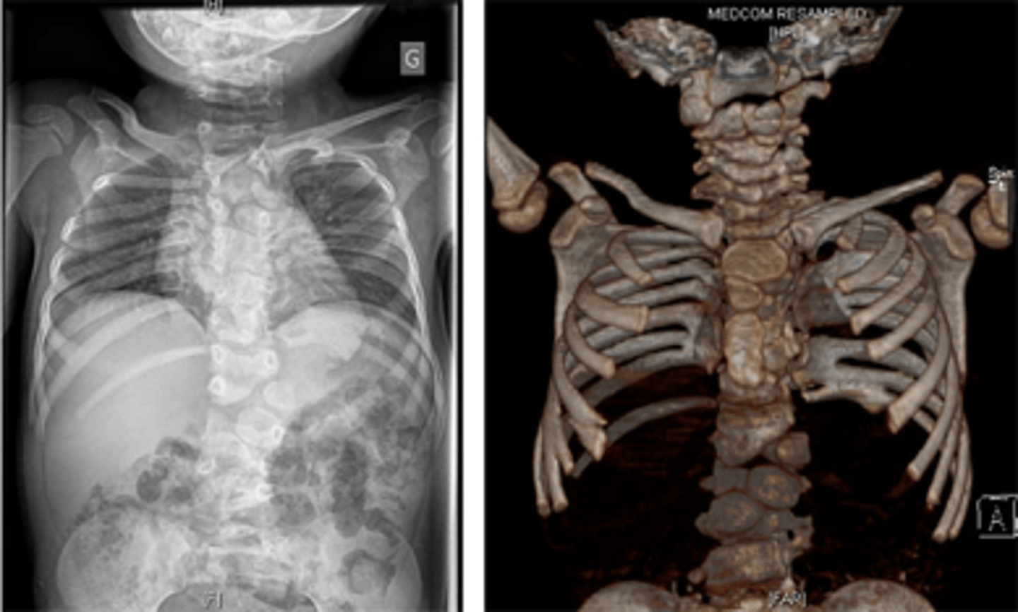 <p>-rare, heritable disorder<br>-widespread malformation of the vertebral column and ribs<br>-mutations in genes that code for proteins in segmentation clock</p>