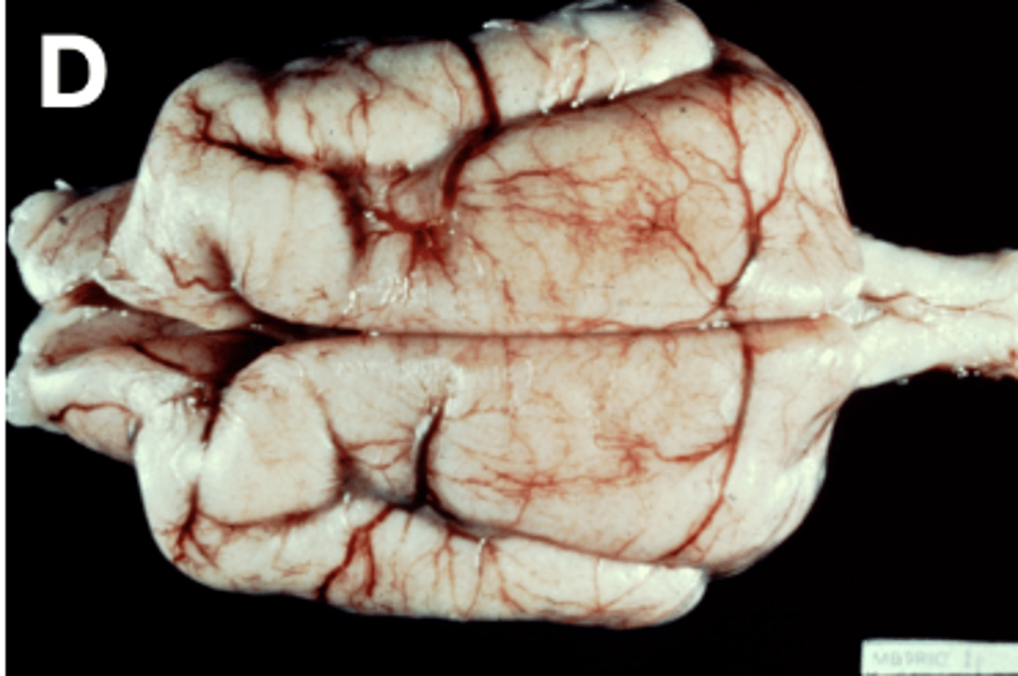 <p>- Thick gyri</p>