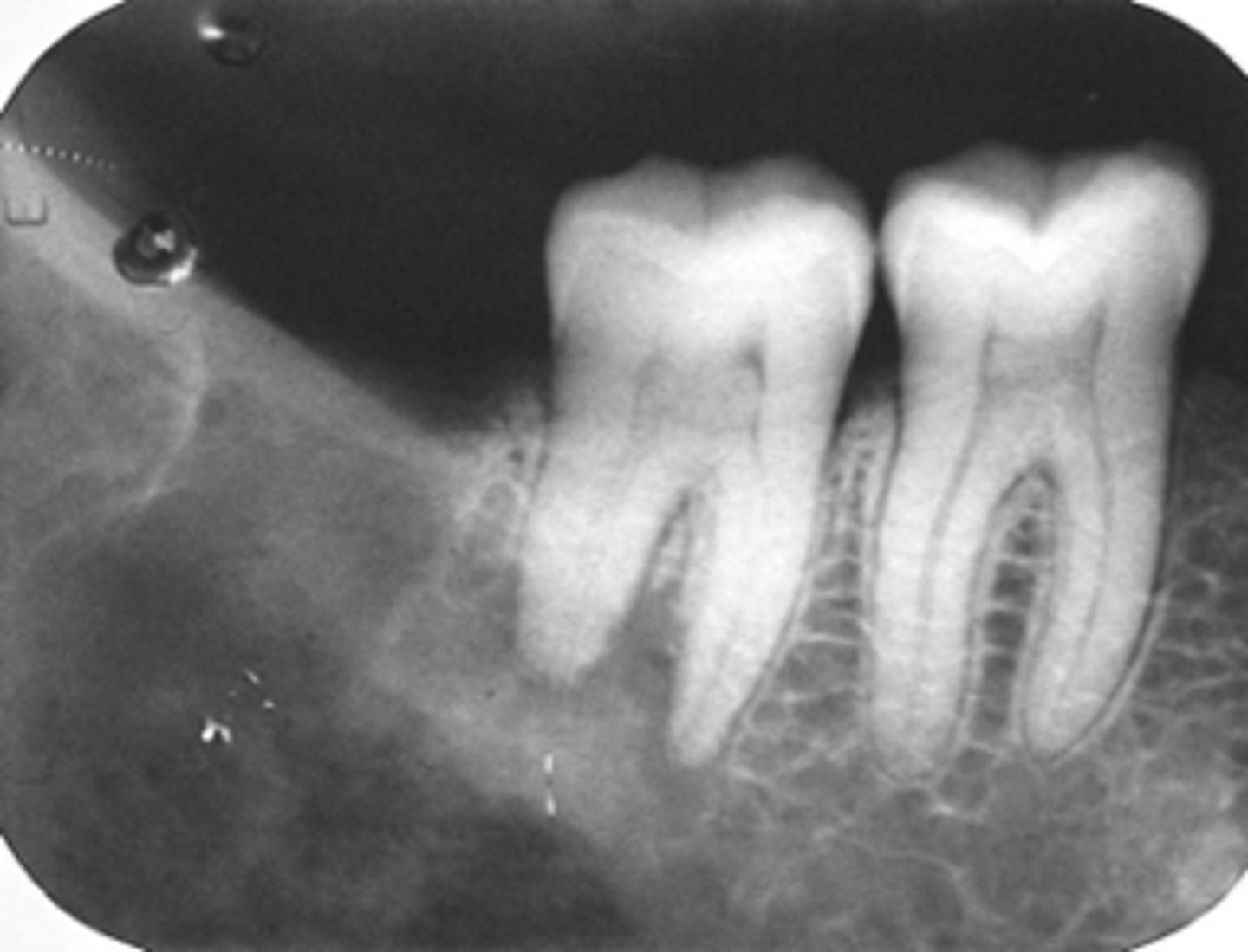 <p>ID the pathology:</p><p>- Non-healing extraction site</p><p>- Ill-defined</p><p>- radioluceny, mixed</p><p>- resorption of roots</p><p>-distruction of lamina dura</p>