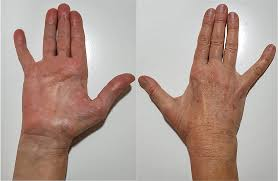 <p>The wasting of the muscles in the base of the thumb due to carpal tunnel syndrome</p>