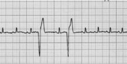 <p>Ventricle is contracting during the wrong time - not following normal path, taking longer </p><ul><li><p>No P waves</p></li><li><p>Premature</p></li><li><p>Bizarre QRS</p></li></ul><p>Premature nature prevents adequate diastolic filling </p><ul><li><p>pulse deficit </p></li></ul><p></p>