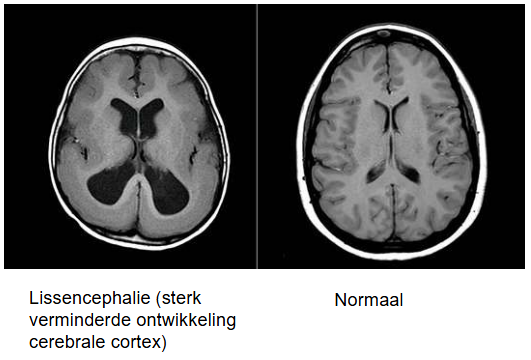 <p>sterk verminderde ontwikkeling van cerebrale cortex</p><ul><li><p>cerebrum ontwikkelt zich nog sterk in tweede en derde trimester zwangerschap</p></li></ul><p></p>