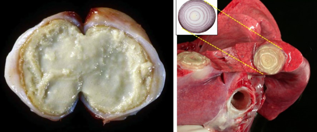 <ul><li><p>Enlarged LN with central core of thick creamy necrotic material, greenish-white &amp; gritty</p></li><li><p>Older lesions = onion skin formed due to concentrically lamellated layers of fibrous connective tissue with alternating zones of caseous friable material</p></li></ul><p></p>