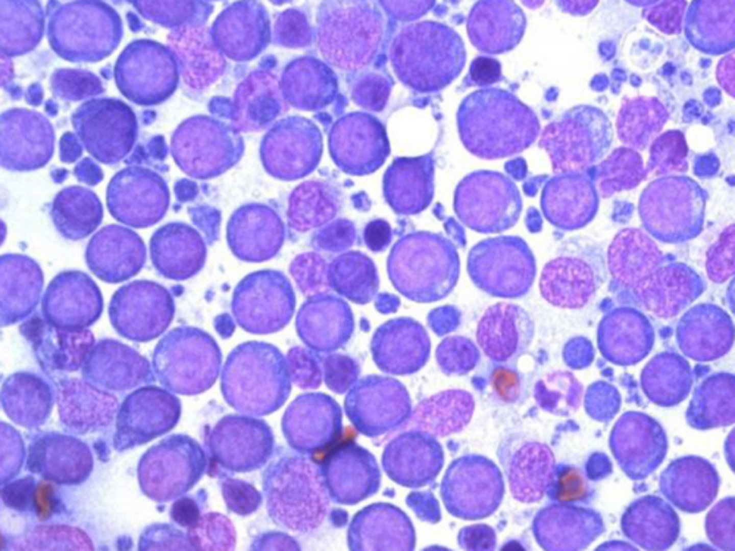 <p>Identify the type of round cell neoplasia?</p>