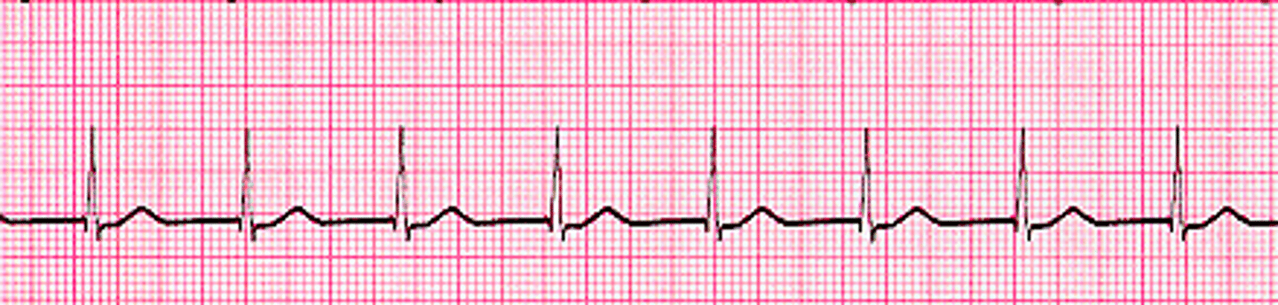 <p>Regular</p><p>Rate: 60-100</p><p>P Wave: NONE or INVERTED</p><p>PR Interval: None or &lt;0.12</p><p>QRS: &lt;0.12 sec</p>