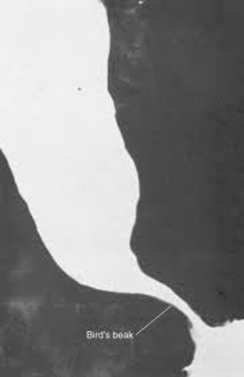 <p>achalasia → birds beak taper of esophagus</p><p>caused by failure of LES to relax d/t inhibitory neurons in the esophagus</p>