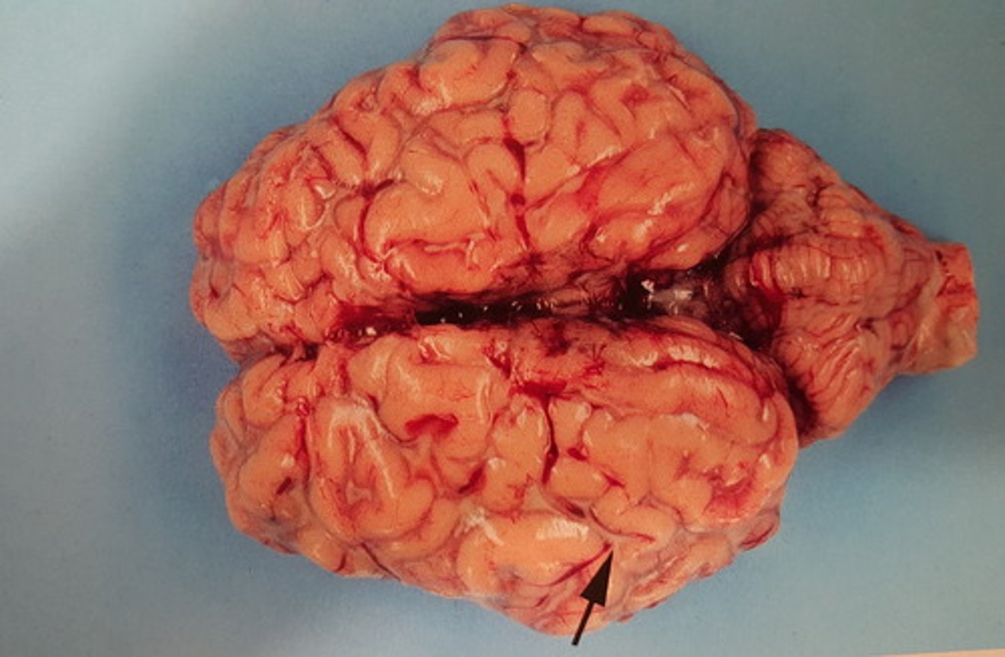 <p>Hjerne fra okse. Patoanatomisk diagnose? Ætiologi?</p>