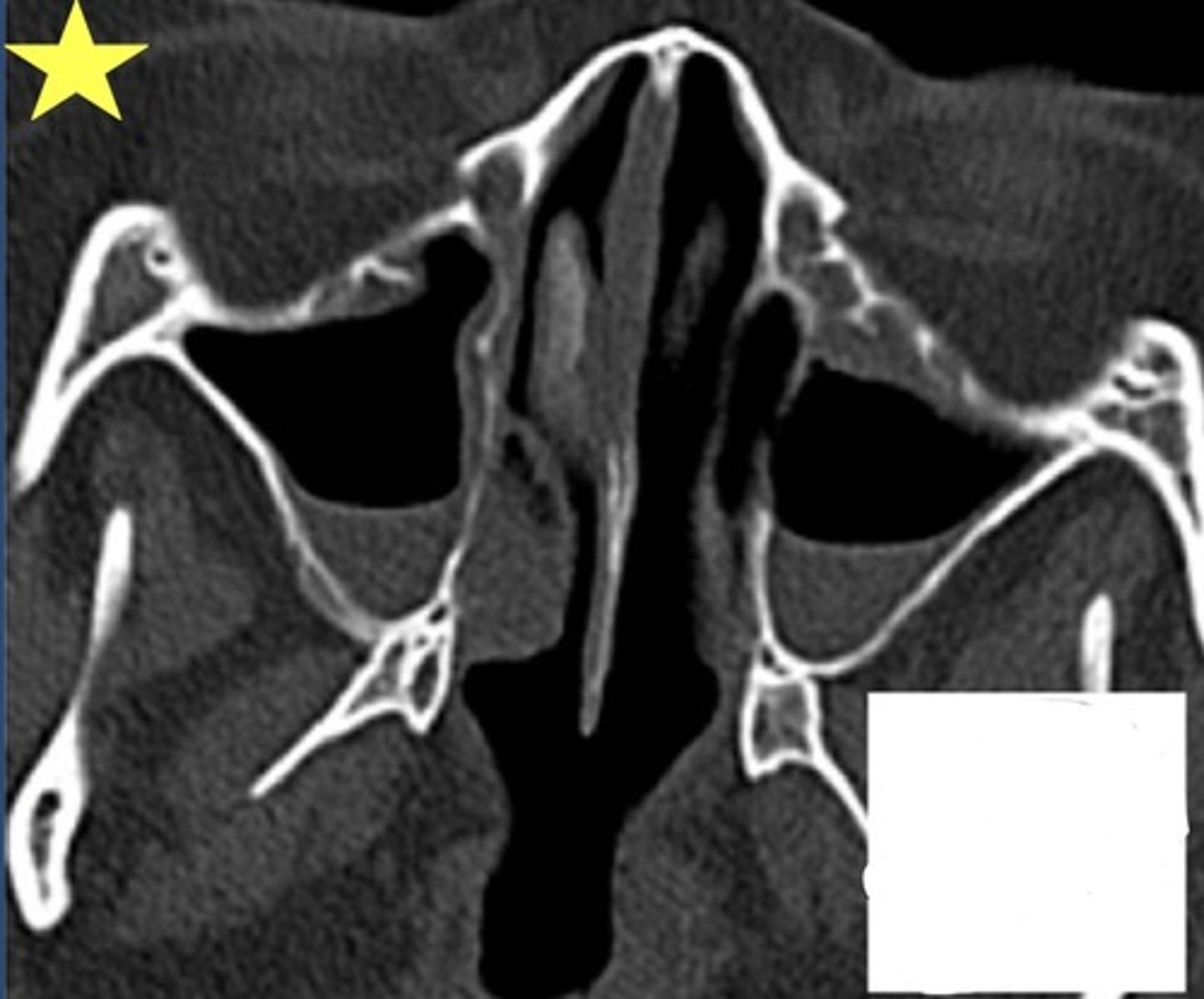 <p>Identify the radiographic abnormality. Also identify the imaging plane and modality used.</p>