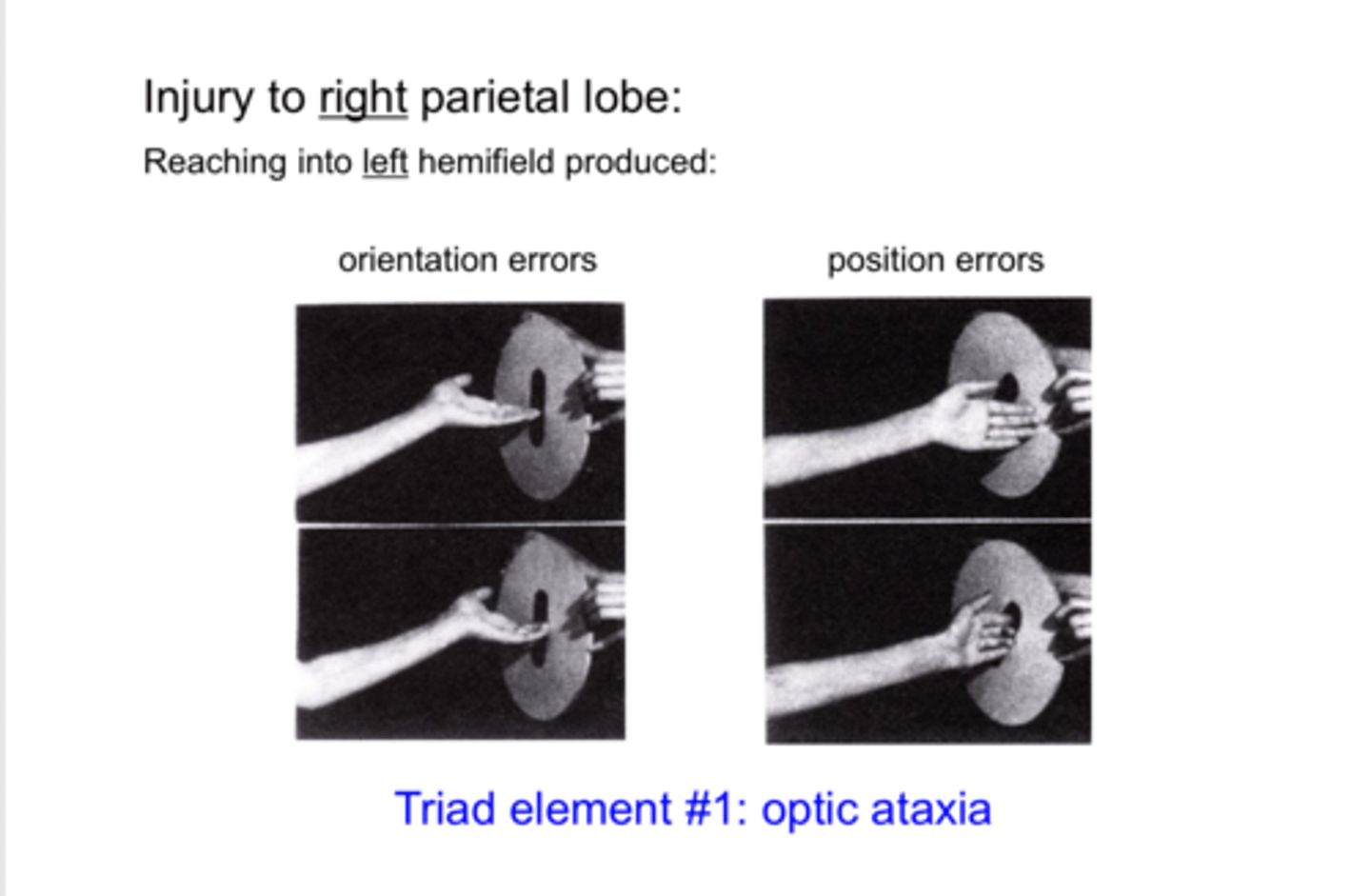<p>When an injury to the RIGHT parietal lobe is present and the patient reaches into their LEFT hemifield. What is the result?</p>