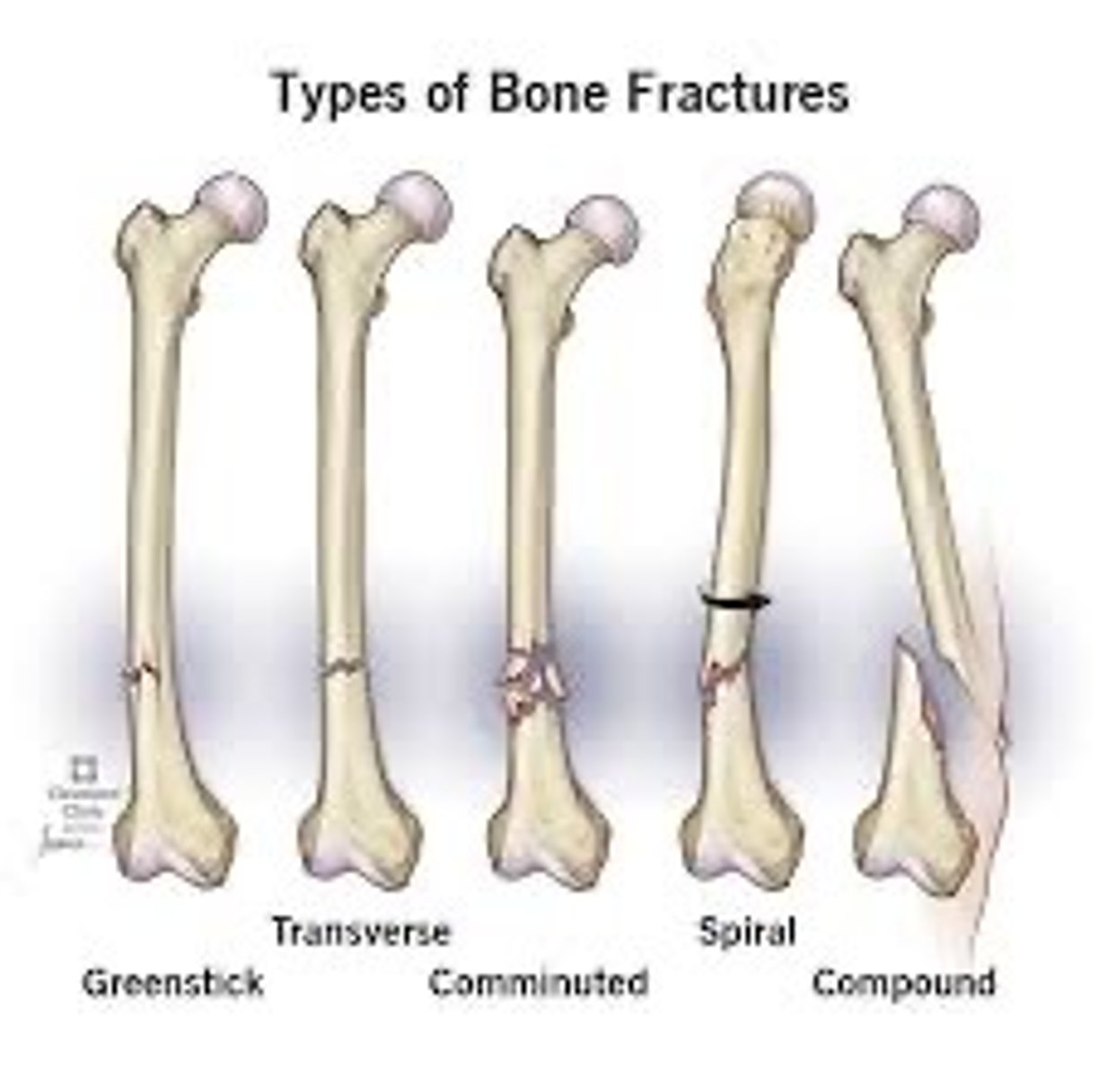<p>- long bone fractures</p><p>- range of onset => 3 hours-3 days post injury</p>