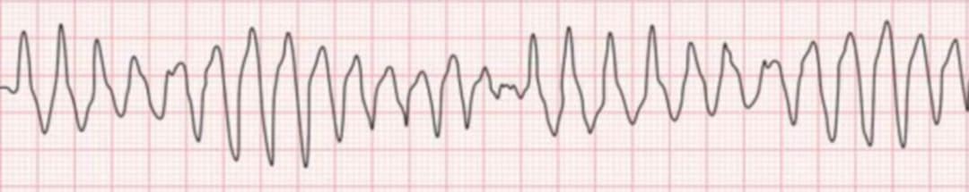 <p>what rhythm is shown in the ECG?</p>