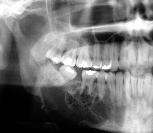 <p>likely diagnosis of this lesion </p>