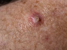 <p>Squamous Cell Carcinoma</p>