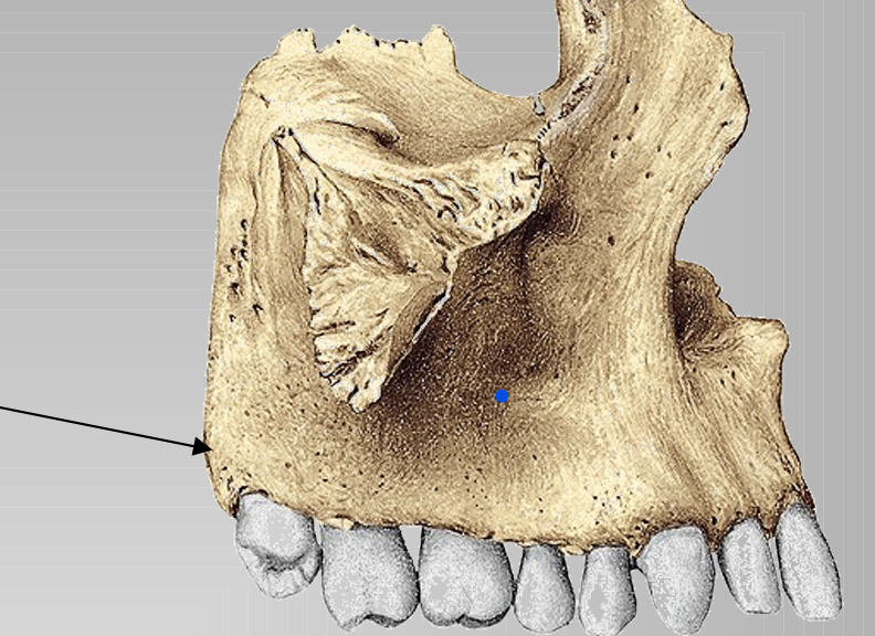 <p>verdikking op maxillae</p>