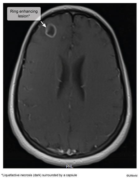 <p>22yo with new generalized tonic-clonic seizure, 3-week hx progressive headaches, fever, nasal congestion, &amp; rhinorrhea. HIV -.</p>