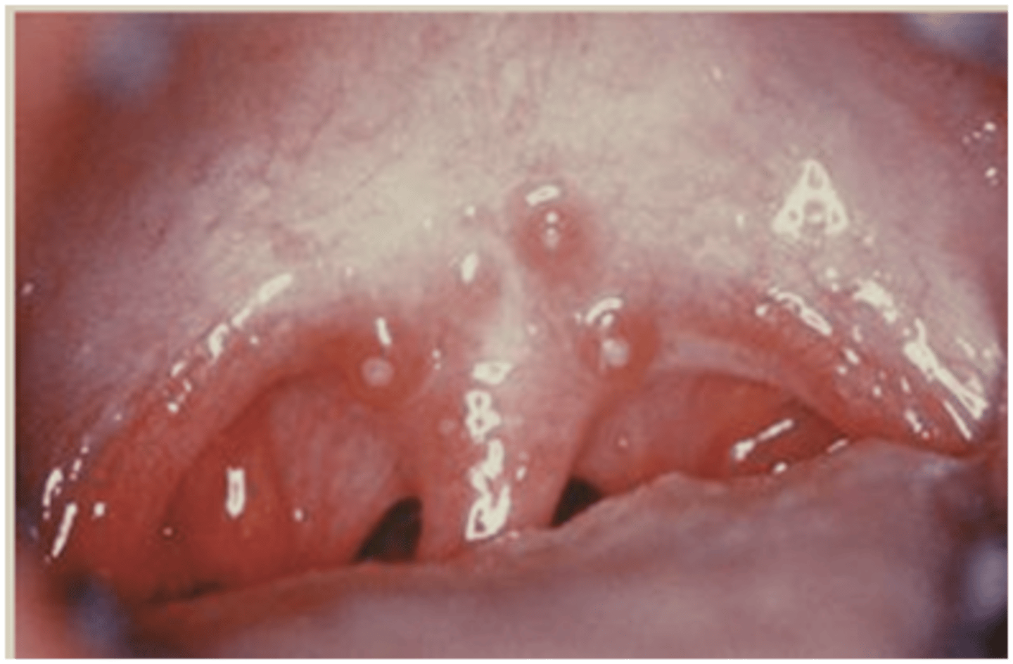 <p>yellow-reddish nodules of tonsils/soft palate</p><p>• Coxsackie virus</p><p>• population: children</p>