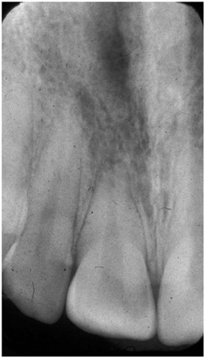 <p>Vertical angulation too high</p>