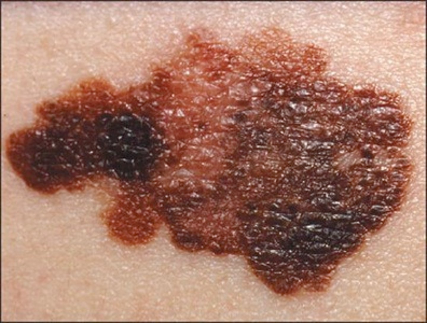 <p>Skin cancer arising from the pigment-producing melanocytes in the epidermis that give the skin its color; lethal due to high rate of metastasis</p>