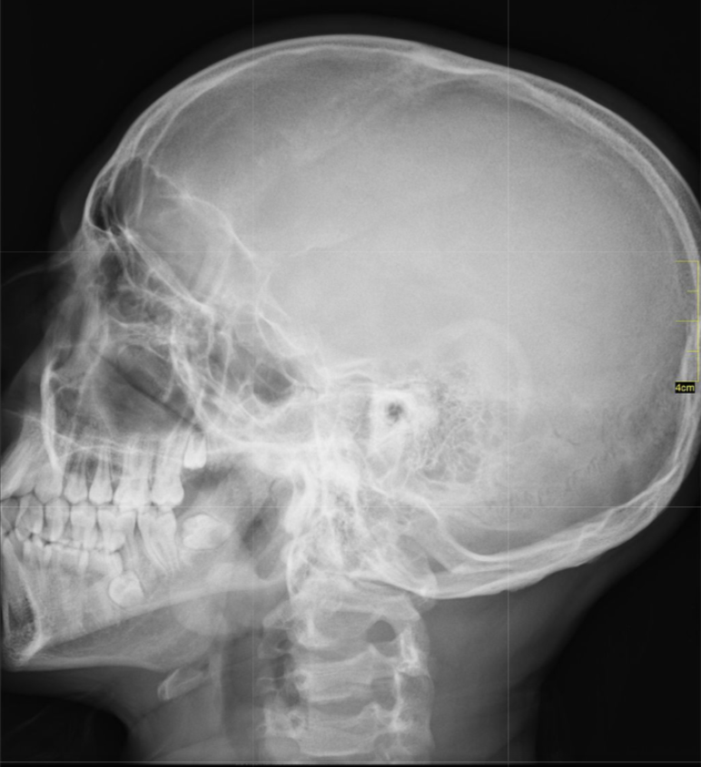 X-ray scans provide a two-dimensional image of the interior of the body. X-rays are often used to provide images of the chest or broken bones.