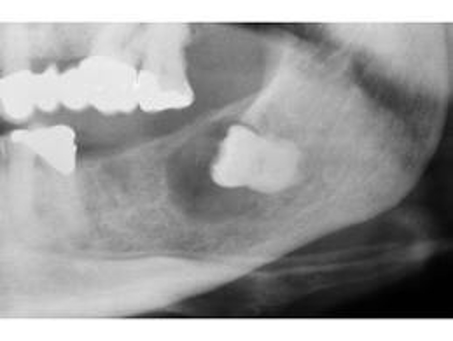 <p>the radiolucency in this radiograph appears to be a:</p><p>a. abscess</p><p>b. primordial cyst</p><p>c. dentigerous cyst</p><p>d. eruption cyst</p>