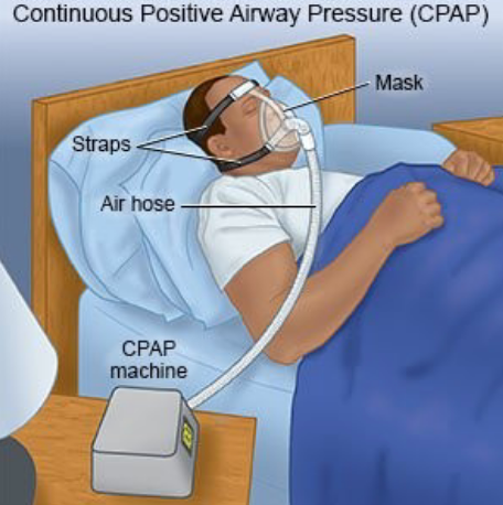 <ul><li><p><strong>One constant pressure is delivered during both inspiration and expiration</strong> (8-10 cmH2O)</p></li><li><p>The main clinical role is to <strong>splint the upper airway open, preventing collapse</strong> (e.g., in <strong>obstructive sleep apnea</strong>)</p></li><li><p>Because pressure is continuous, it helps improve oxygenation by increasing functional residual capacity (FRC) and preventing alveolar collapse — but it doesn’t actively help with ventilation (CO₂ removal)</p></li><li><p>Think of CPAP as a “pneumatic stent” that k<strong>eeps the airway and alveoli open all the time</strong></p></li></ul><p></p>