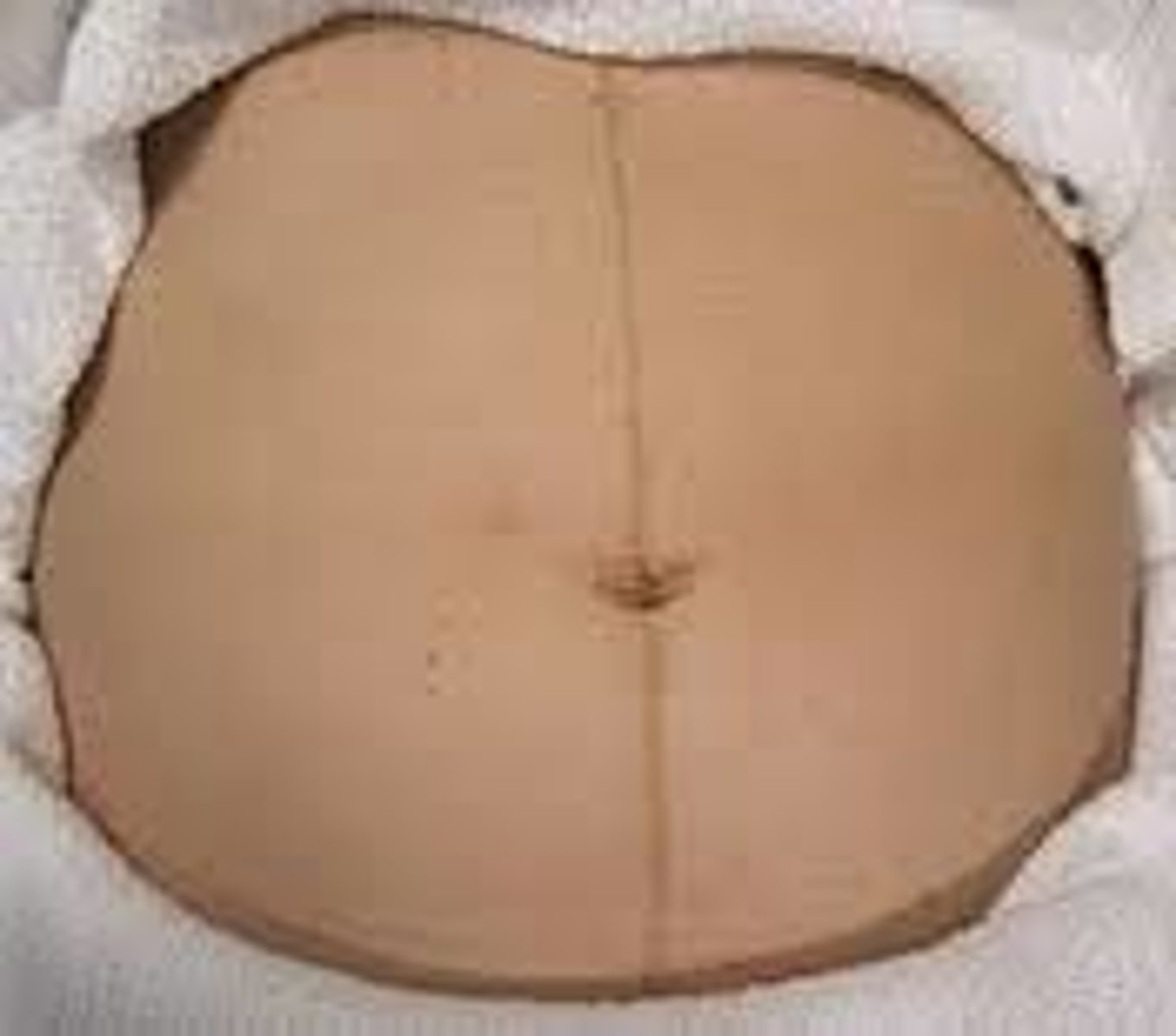 <p>C) Linea nigra</p><p>Explanation: </p><p>C) The linea alba refers to the midline of the abdomen from the pubic area to the umbilicus and above. During pregnancy increased pigmentation may cause this area to darken. It is then referred to as the linea nigra. Some women also develop facial chloasma (or melasma gravidarum), the "mask of pregnancy." This is an irregular pigmentation of the cheeks, forehead, and nose that occurs in many women during pregnancy and is accentuated by sun exposure. </p><p>Striae, or stretch marks, are reddish, wavy, depressed streaks that may occur over the abdomen, breasts, and thighs as pregnancy progresses. They are caused by reduced connective tissue strength due to elevated adrenal steroid levels. Vascular spider nevi may develop on the chest, neck, face, arms, and legs. They are small, bright-red elevations of the skin radiating from a central body. They may be caused by increased subcutaneous blood flow in response to increased estrogen levels.</p>