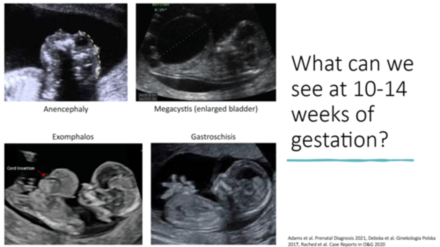 <p>The baby's kidneys are producing urine that's released into the amniotic fluid. The baby can make facial expressions and may begin sucking his or her thumb.</p>