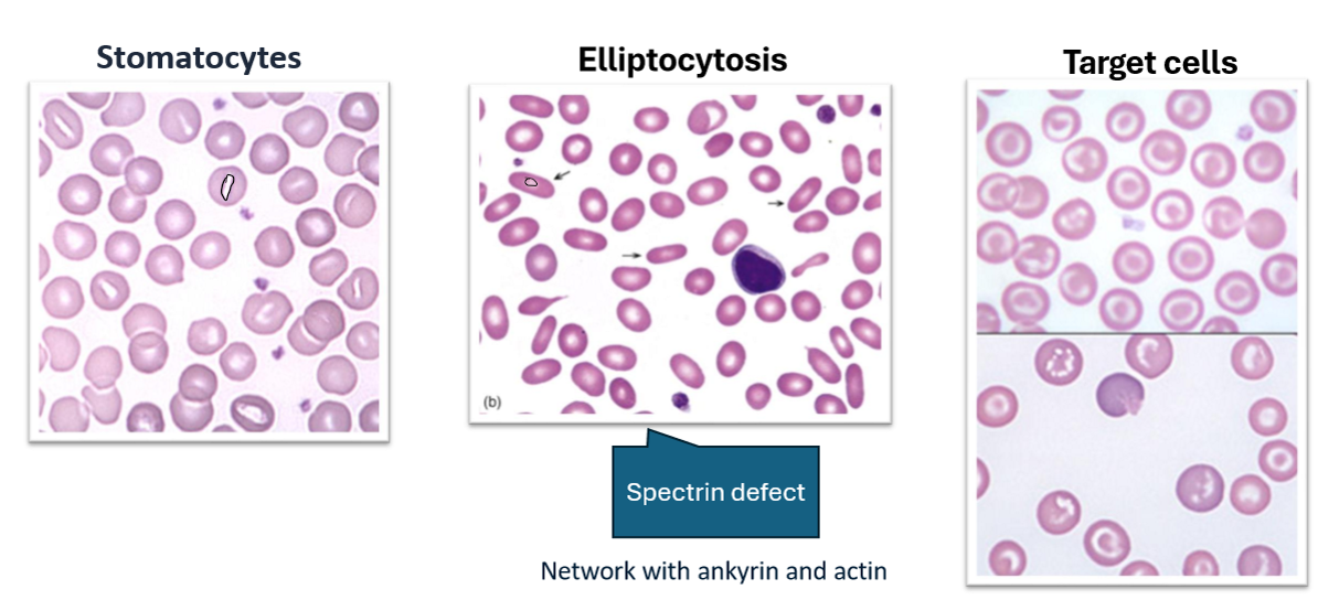 <ul><li><p>Stomacytes</p></li><li><p>Elliptocytosis</p></li><li><p>Target Cells</p></li></ul><p></p>