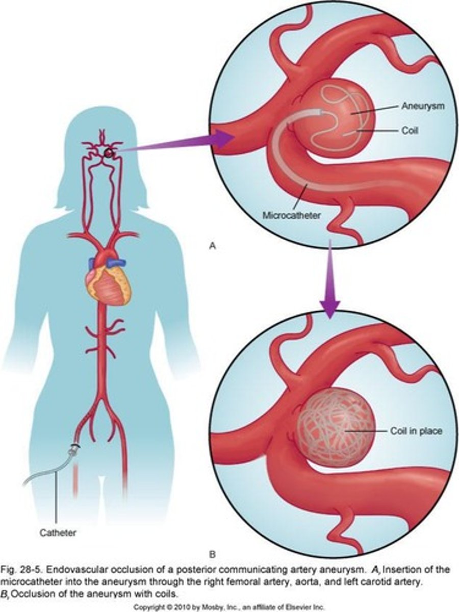<p>Endovascular treatment to occlude aneurysms.</p>